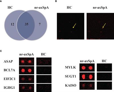 Diagnostic value of anti-Kaiso autoantibody in axial spondyloarthritis